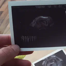 Ein Ultraschallbild, auf dem die Frequenzen der Herztöne aufgezeichnet wurden.